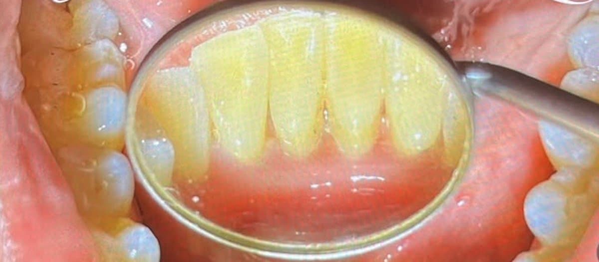 Tartar Removal — Scaling & Polishing after