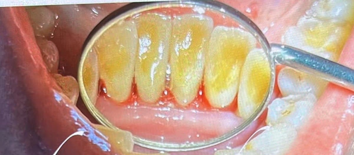 Tartar Removal — Scaling & Polishing before