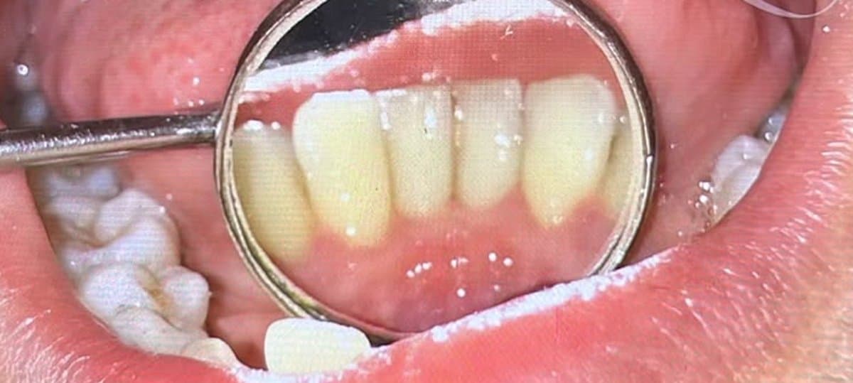 Stain Removal — Scaling & Polishing after