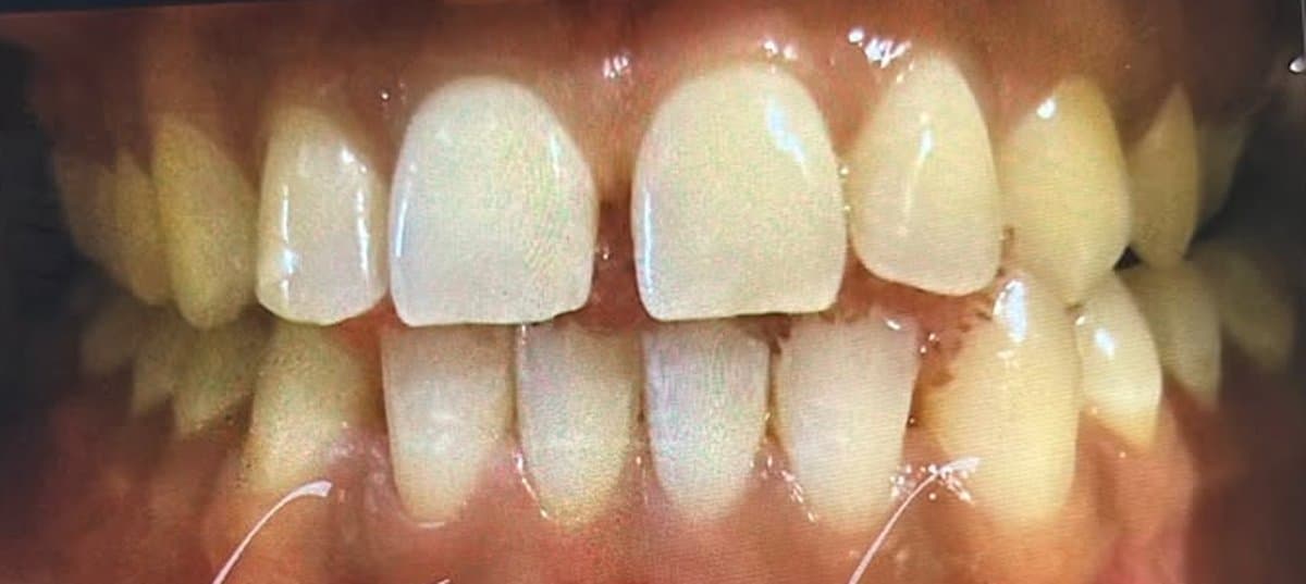 Teeth Whitening before