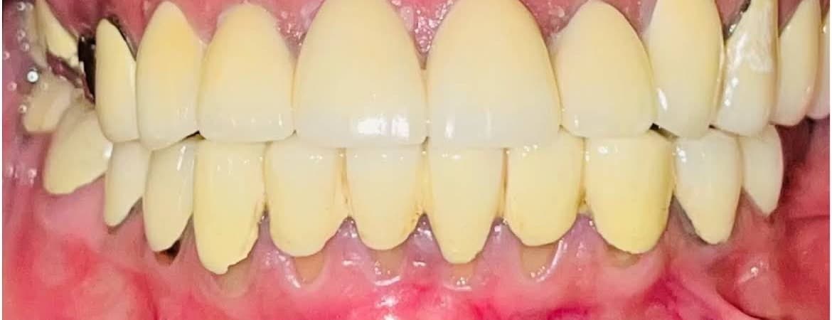 Smile Makeover after