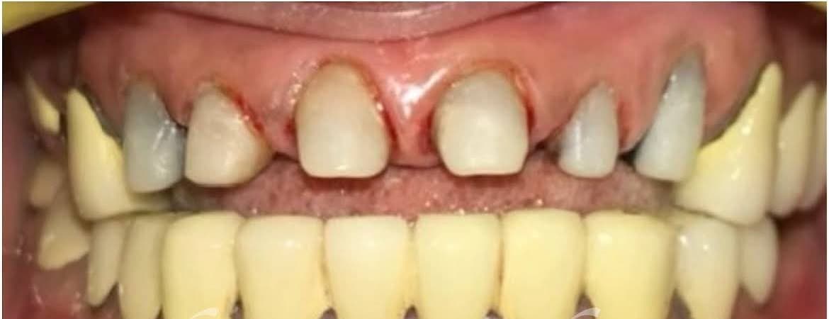 Smile Makeover before