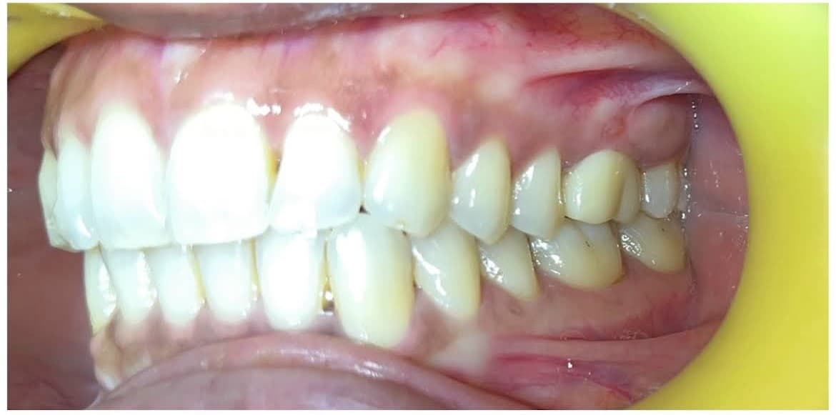 Teeth Whitening — Side View after