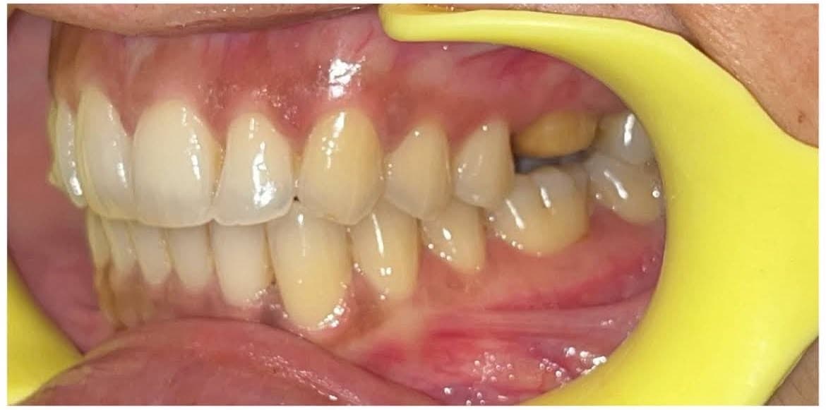 Teeth Whitening — Side View before